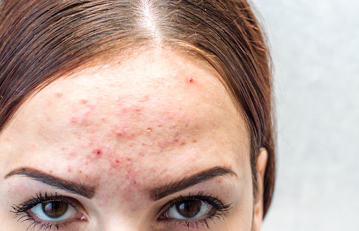 What-Are-The-Causes-Of-Hormonal-Acne